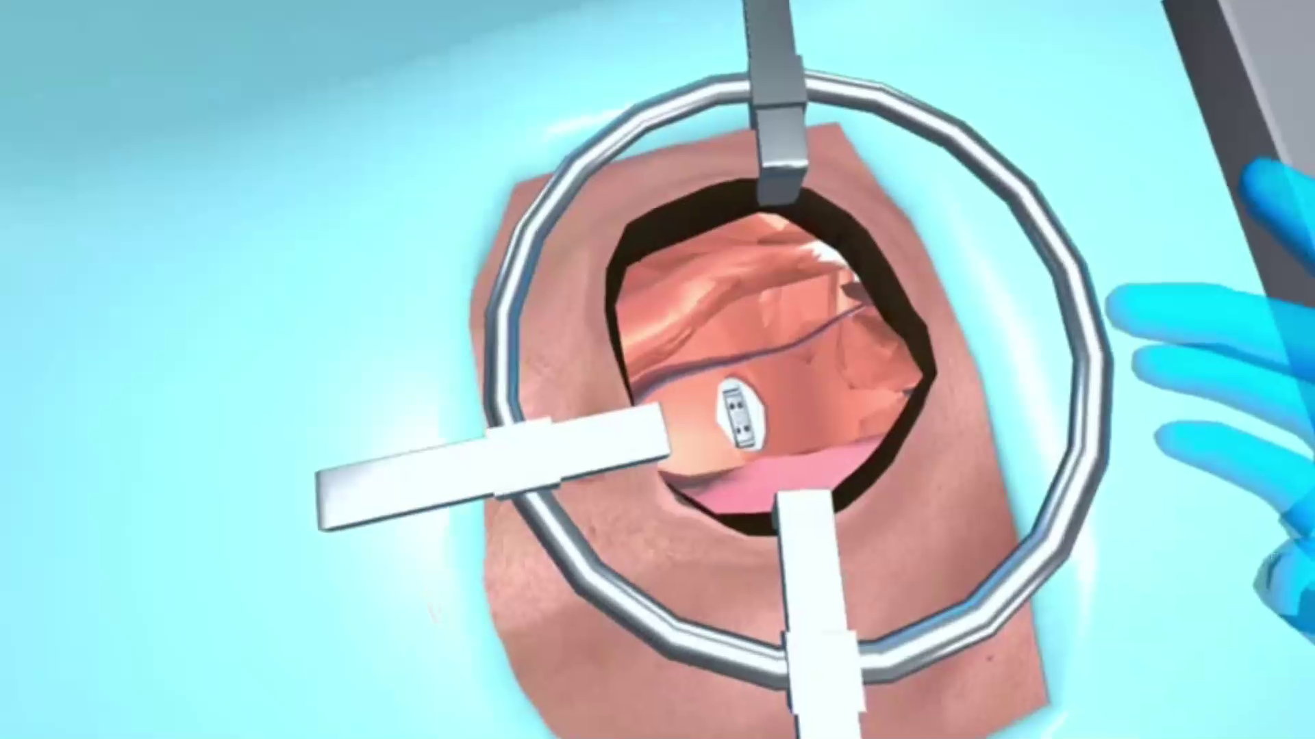 Screenshot showing the implant placement step in VR
